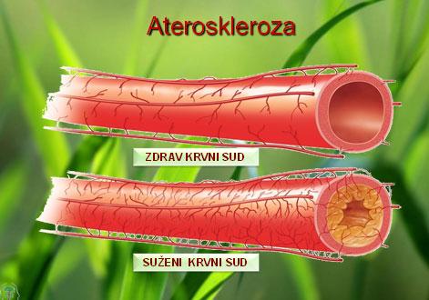 Ateroskleroza