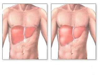 Hepatitis C
