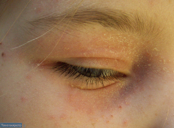 Ksantelasma (Xanthelasma Palpebrarum)