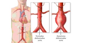 aorta