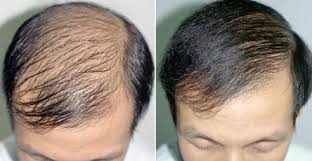 Transplantacija kose