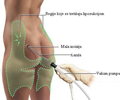 Liposukcija