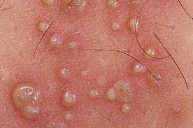 Genitalni herpes