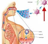 Simptomi cistične fibroze