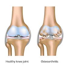 Vitamin D ipak ne pomaže kod osteoartritisa