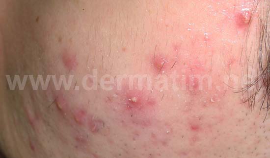 Akne i bubuljice na licu