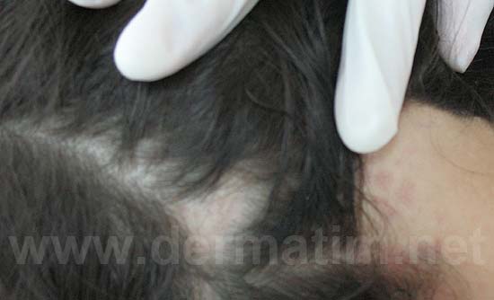 Ćelavost na pečate