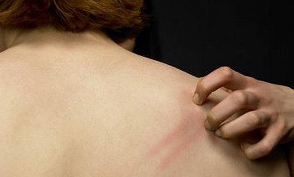 Svrab -lečenje biljem