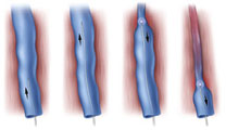 Endovenski laserski tretman (EVLA)