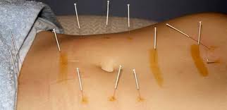 Akupunktura odlična za policistične jajnike