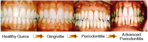 gingivitis