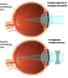kratkovidnost