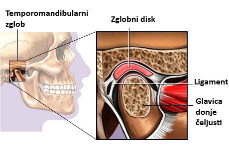 Poremećaj temporomandibularnog zgloba