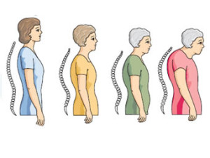 bolest_kostiju_osteoporoza_lecenje_biljem