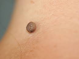 Mladeži i melanomi – istine i zablude