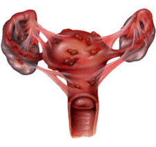 Endometritis