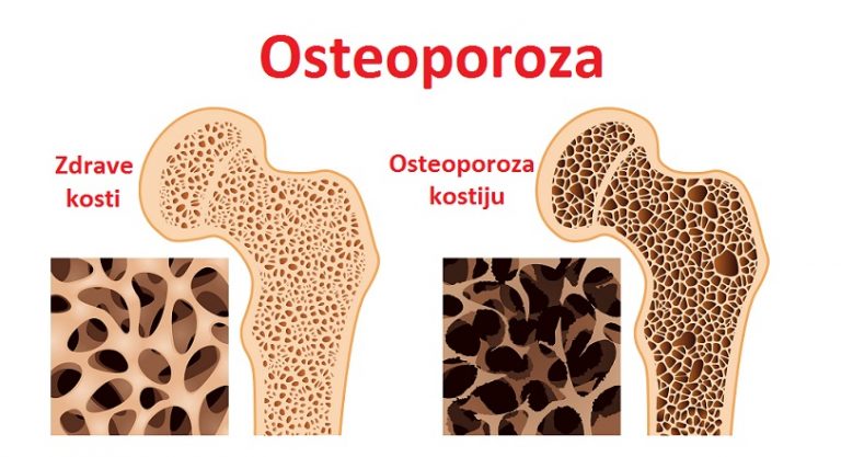 Osteoporoza- podmukla bolest današnjice