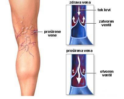 Prevencija pojave proširenih vena