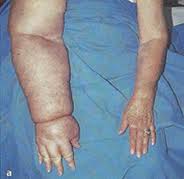 Zadržavanje vode u telu