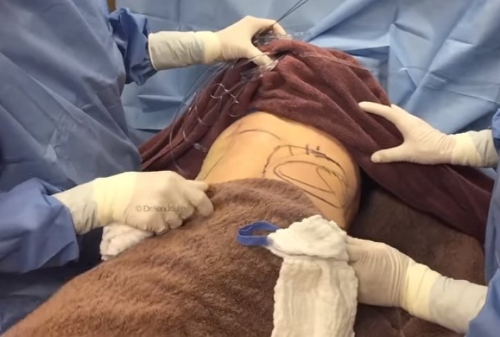 Liposukcija- sve što je potrebno znati