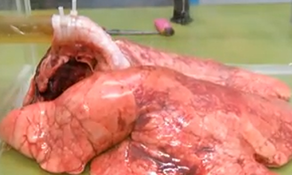 Pogledajte kako izgledaju pluća posle samo 60 cigareta