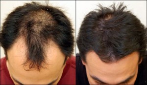 hair_transplant