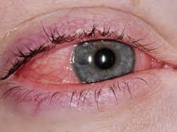 Šta izaziva konjunktivitis i kako ga lečiti