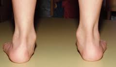 Ravna stopala kod dece