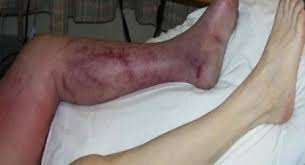 Venska tromboza- lečenje