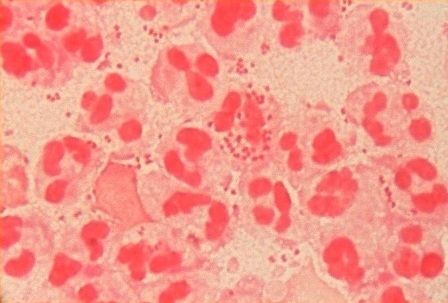 Uretritis – simptomi i lečenje