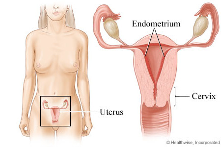 Endometrioza – lečenje prirodnim putem