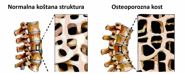 Prepoznajte na vreme prve simptome osteoporoze