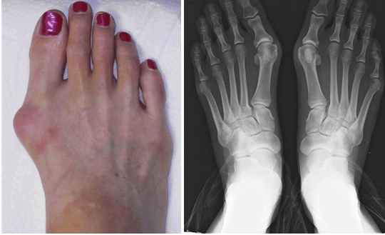 Lovor provereno ublažava bolove od čukljeva