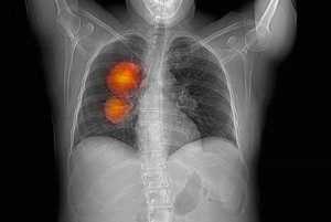 Rak-pluca003