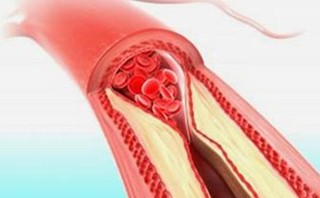 Namirnice koje rešavaju zakrčenja arterija i masnoću u krvi