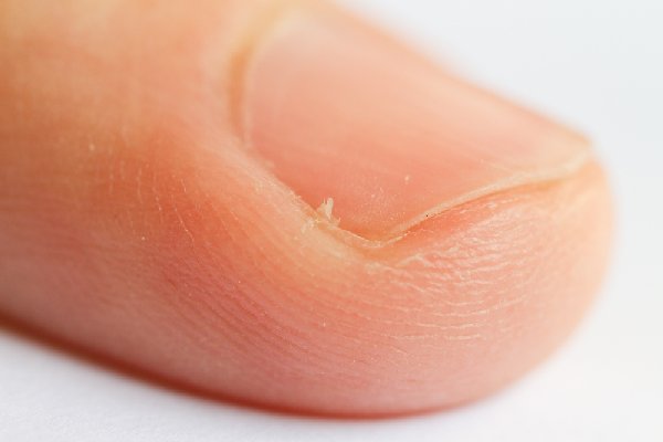 Rešite se zanoktica na vrlo jednostavan način