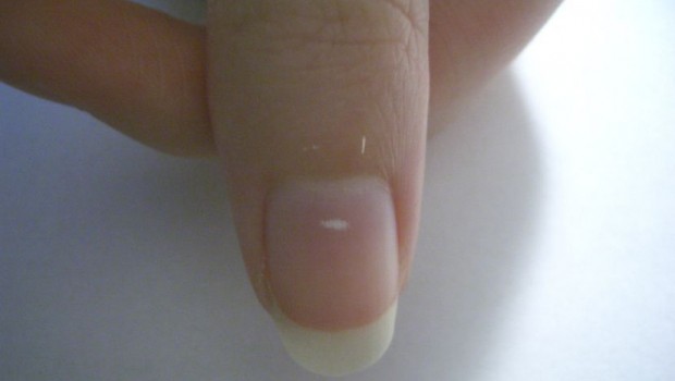 Razlozi zašto se pojavljuju bele fleke na noktima