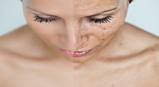 Prirodna rešenja koja će reći zbogom pegama i flekama!