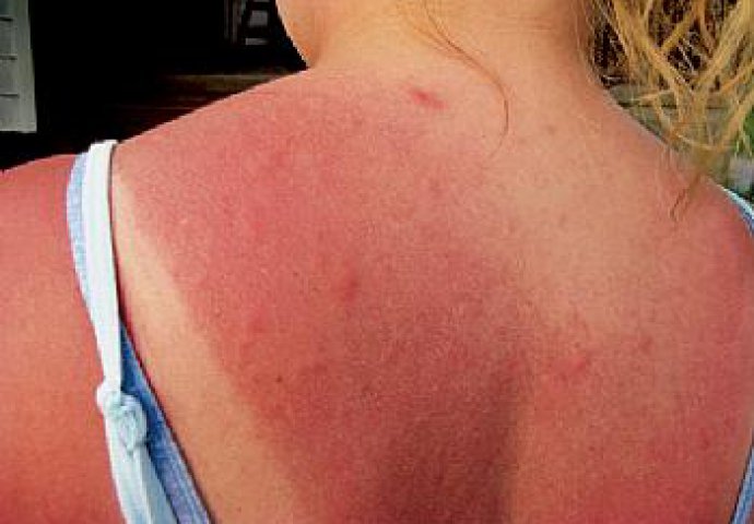 Alergija na sunce- simptomi i lečenje