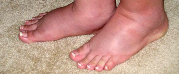 Sprečite oticanje nogu