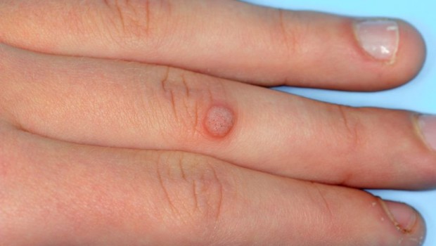 Najdelotvorniji lek za uklanjanje virusnih bradavica