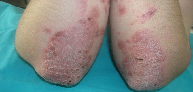 Narodni recepti za lečenje psorijaze
