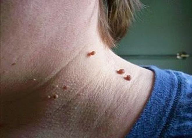 Način na koji ćete se rešiti bradavica za samo 10 dana!