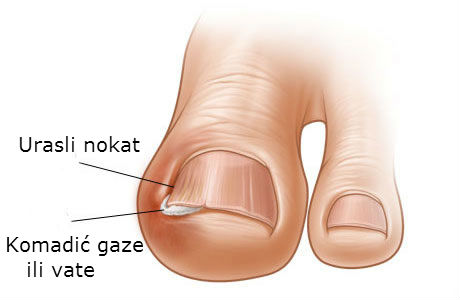 EVO KAKO SE REŠITI URASLOG NOKTA BEZ ODLASKA LEKARU