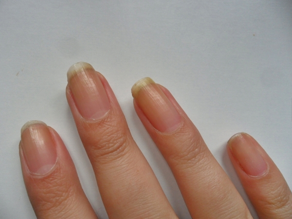 Izbelite požutele nokte od duvana