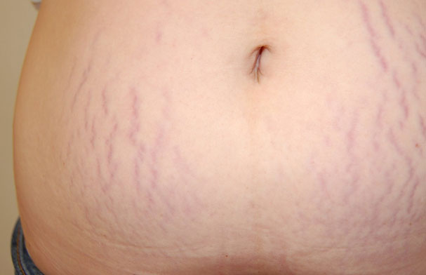 Domaća krema protiv strija