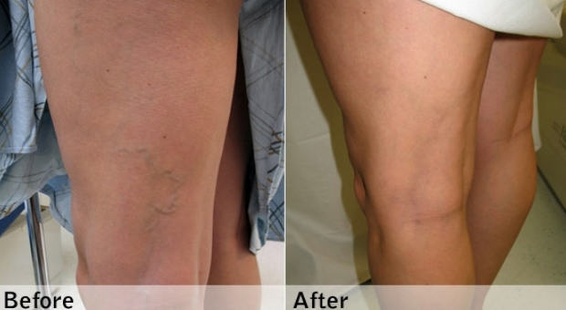 Provereno najbolji lek za proširene vene