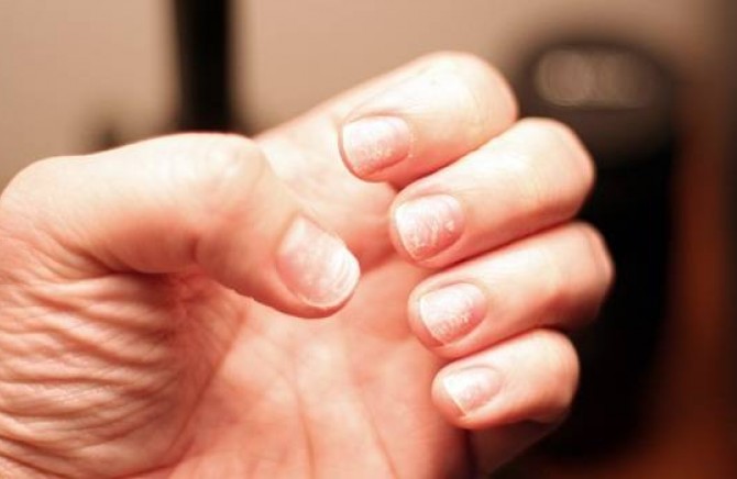 Kako brzo rešiti listanje noktiju