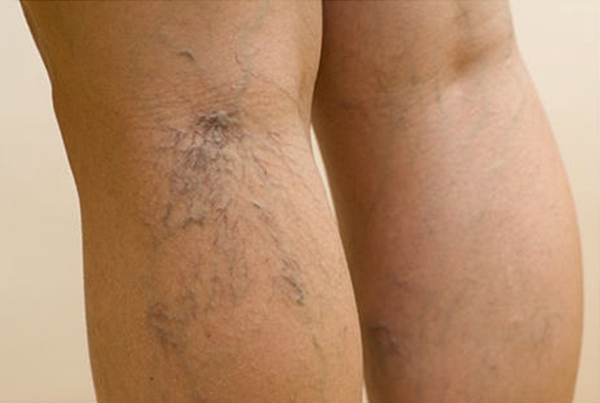 Rešenje za proširene vene i hemoroide