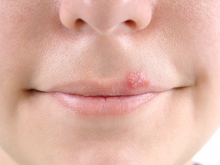 Saveti kojima ćete sprečiti pojavu herpesa